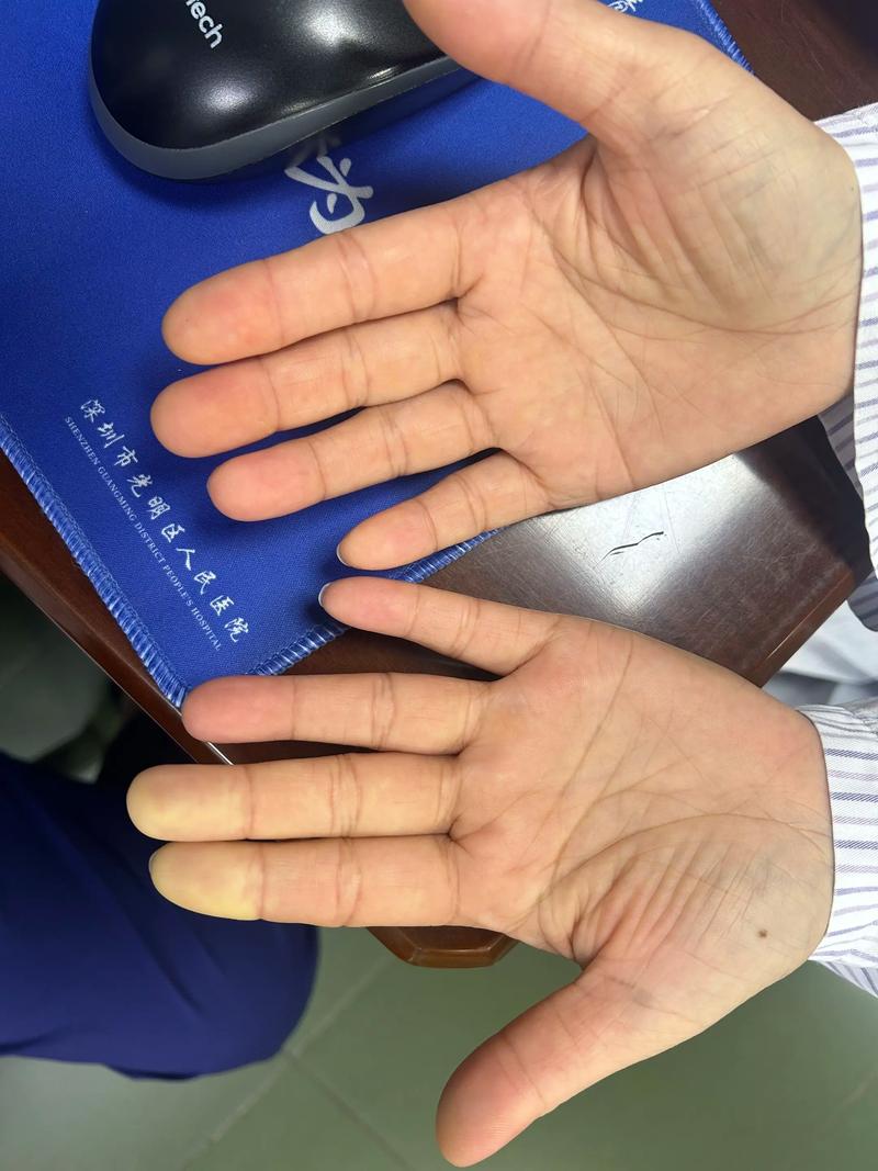 雷诺现象属于什么病怎么治疗 什么叫雷诺现象？常见于哪些疾病？它发生的原因是什么？